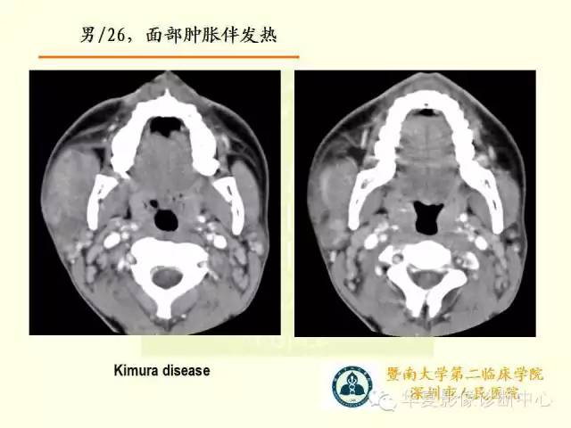 【PPT】颊间隙影像学解剖与病变的诊断