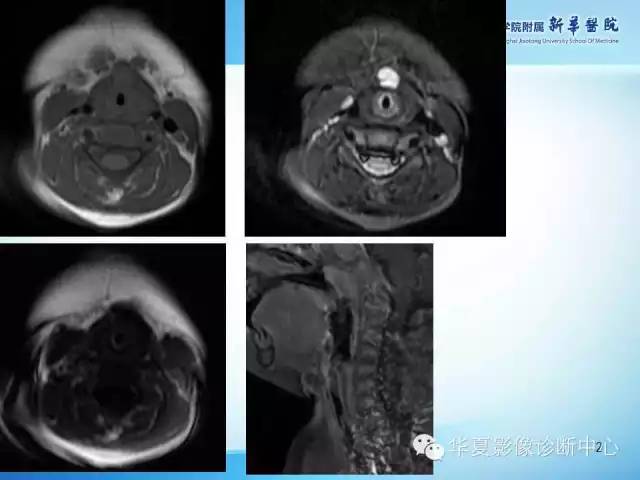 【PPT】颈部常见病变影像学诊断与鉴别