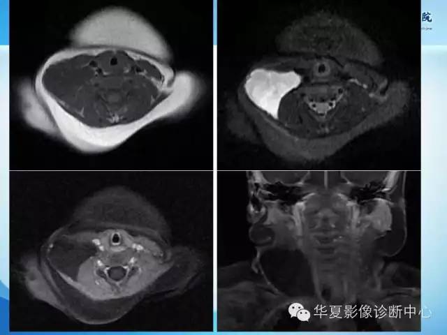 【PPT】颈部常见病变影像学诊断与鉴别