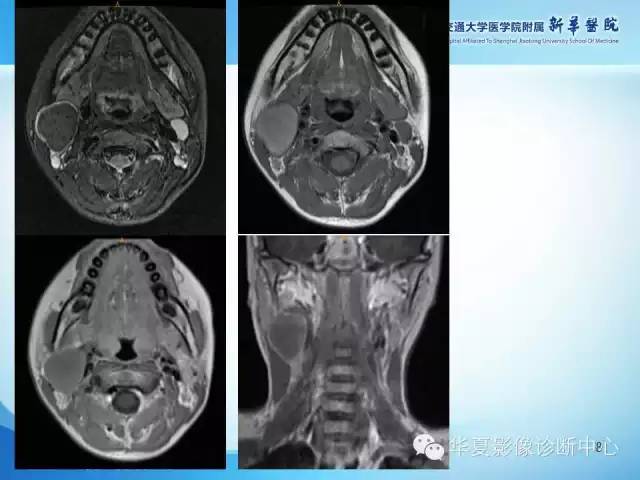 【PPT】颈部常见病变影像学诊断与鉴别