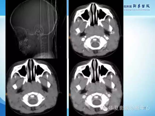 【PPT】颈部常见病变影像学诊断与鉴别