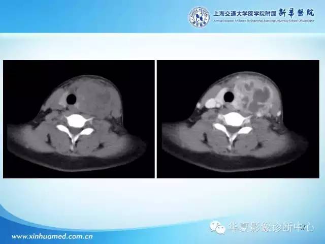 【PPT】颈部常见病变影像学诊断与鉴别