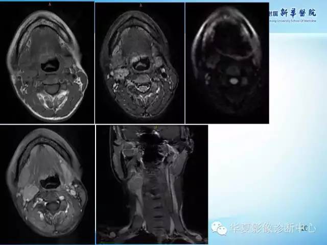 【PPT】颈部常见病变影像学诊断与鉴别