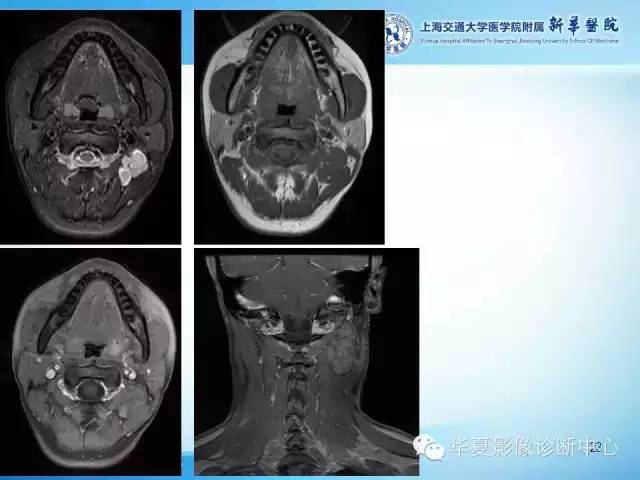 【PPT】颈部常见病变影像学诊断与鉴别