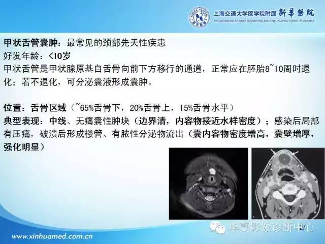 【PPT】颈部常见病变影像学诊断与鉴别