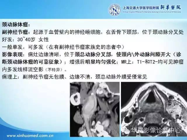 【PPT】颈部常见病变影像学诊断与鉴别