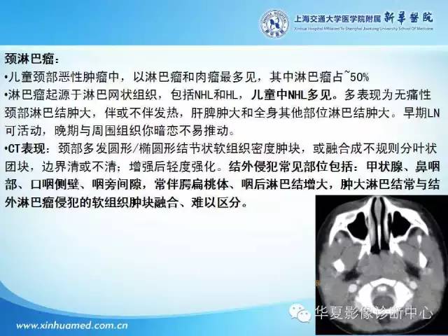 【PPT】颈部常见病变影像学诊断与鉴别