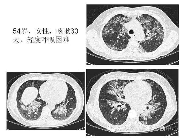 【病例】肺泡蛋白沉着症1例CT影像表现