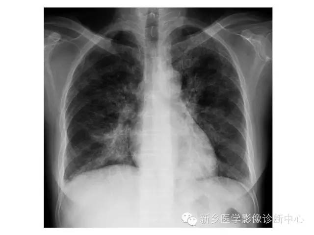 【病例】肺泡蛋白沉着症1例CT影像表现