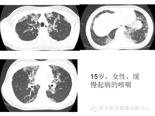 【病例】肺泡蛋白沉着症1例CT影像表现