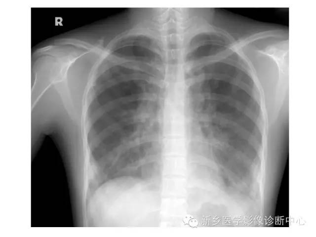 【病例】肺泡蛋白沉着症1例CT影像表现