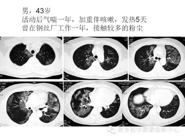 【病例】肺泡蛋白沉着症1例CT影像表现