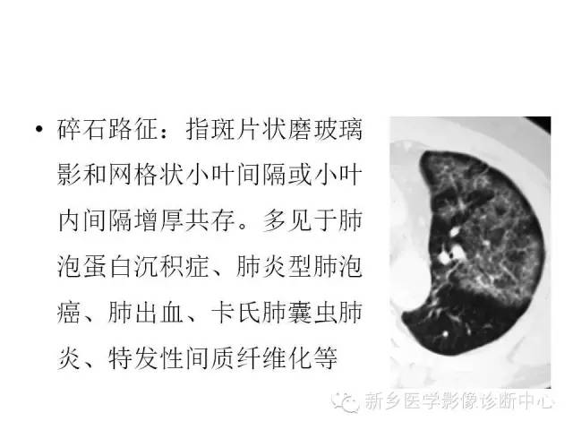 【病例】肺泡蛋白沉着症1例CT影像表现