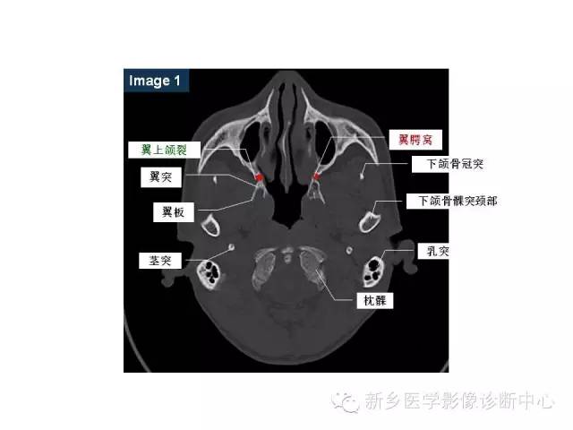 鼻咽部的详细解剖（含各个孔道）