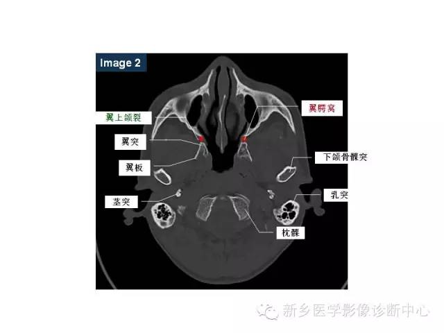 鼻咽部的详细解剖（含各个孔道）