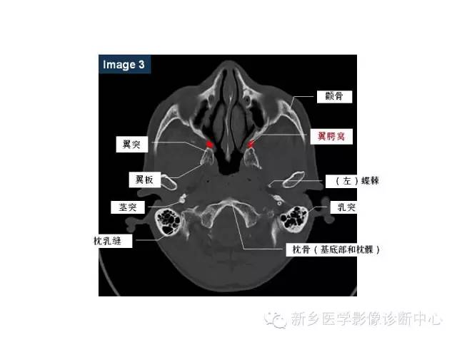 鼻咽部的详细解剖（含各个孔道）