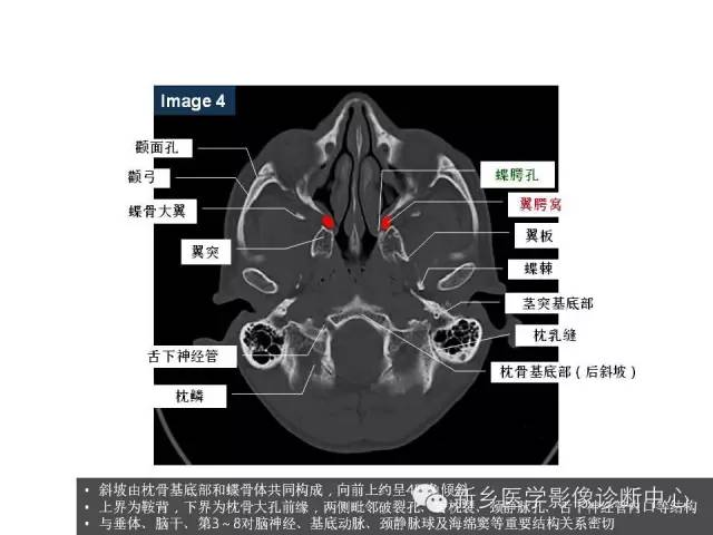 鼻咽部的详细解剖（含各个孔道）