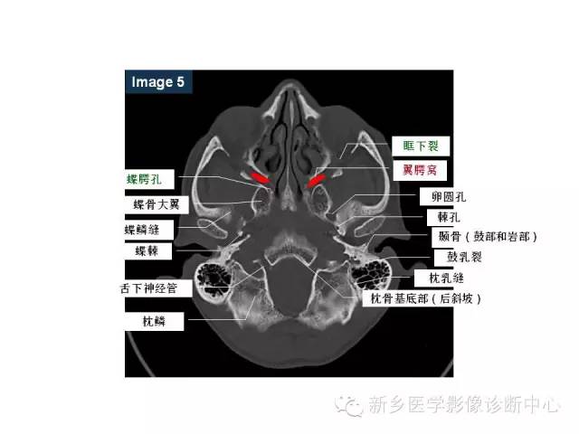 鼻咽部的详细解剖（含各个孔道）