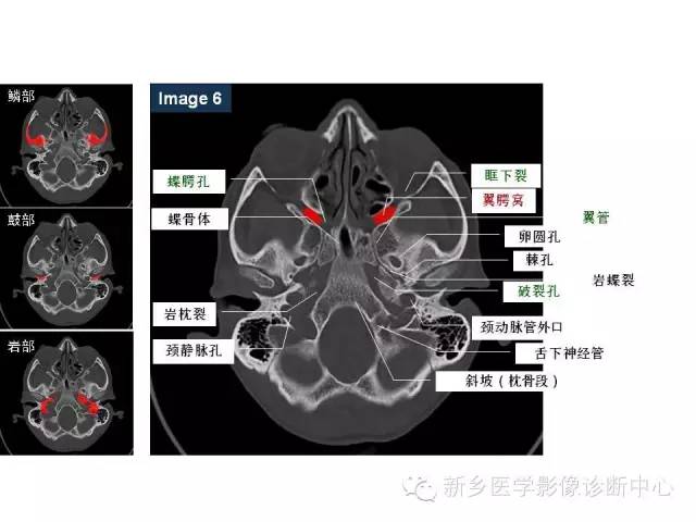 鼻咽部的详细解剖（含各个孔道）