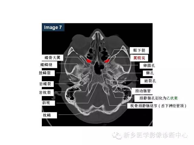鼻咽部的详细解剖（含各个孔道）