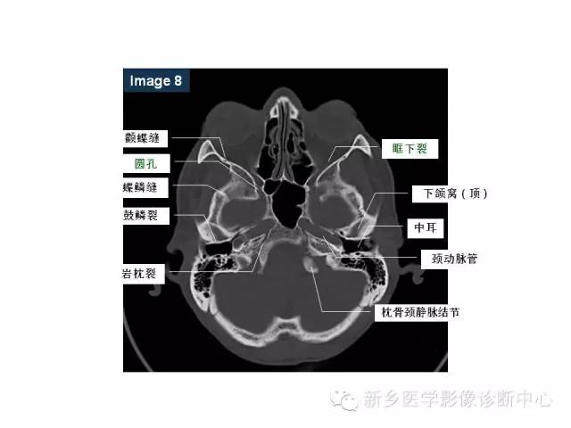 鼻咽部的详细解剖（含各个孔道）