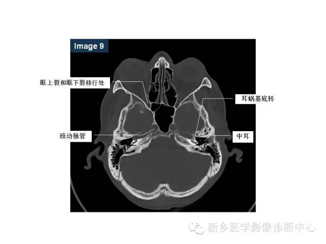 鼻咽部的详细解剖（含各个孔道）