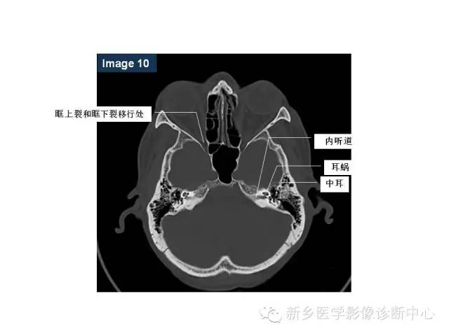 鼻咽部的详细解剖（含各个孔道）