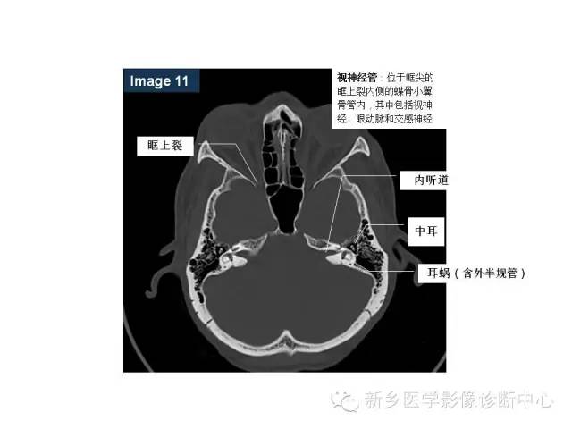 鼻咽部的详细解剖（含各个孔道）
