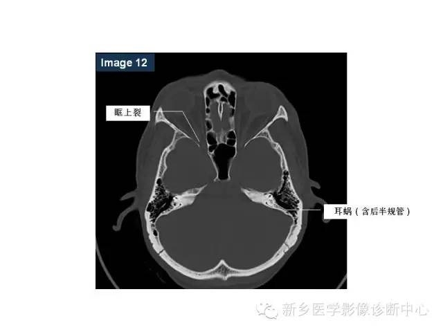 鼻咽部的详细解剖（含各个孔道）