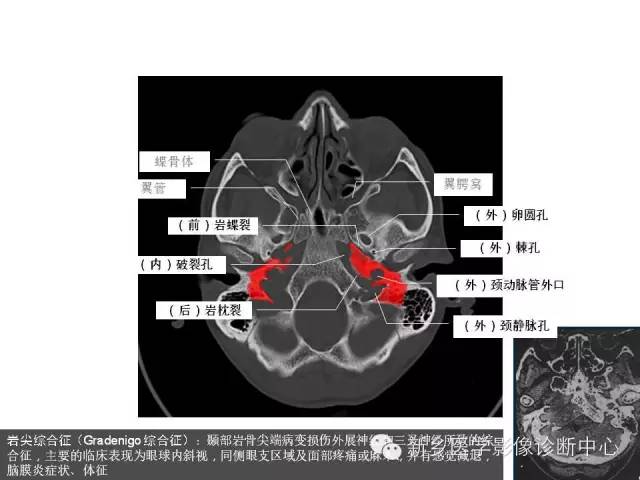 鼻咽部的详细解剖（含各个孔道）