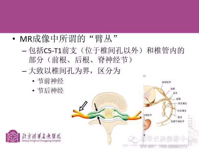 【PPT】臂丛的MR成像