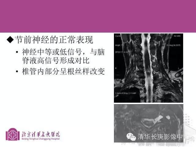 【PPT】臂丛的MR成像