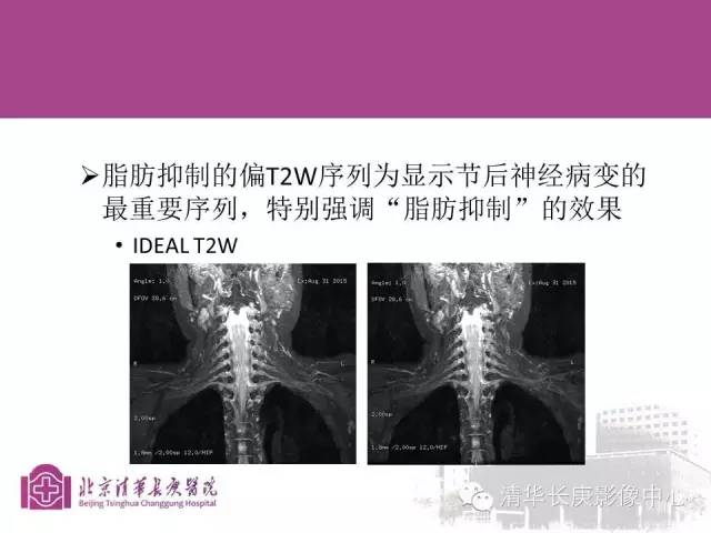 【PPT】臂丛的MR成像