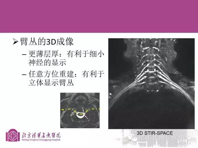 【PPT】臂丛的MR成像