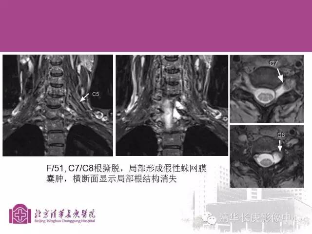 【PPT】臂丛的MR成像
