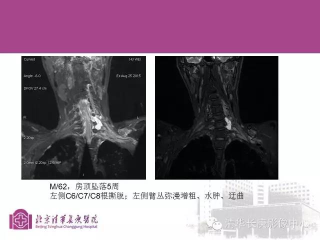 【PPT】臂丛的MR成像