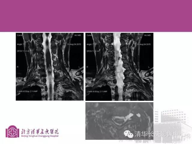 【PPT】臂丛的MR成像