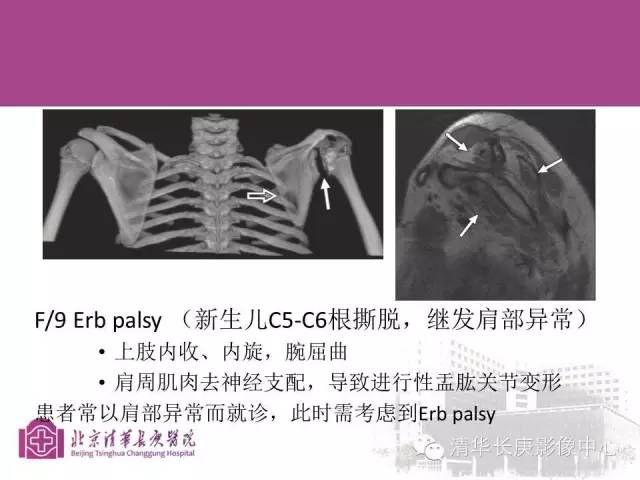 【PPT】臂丛的MR成像