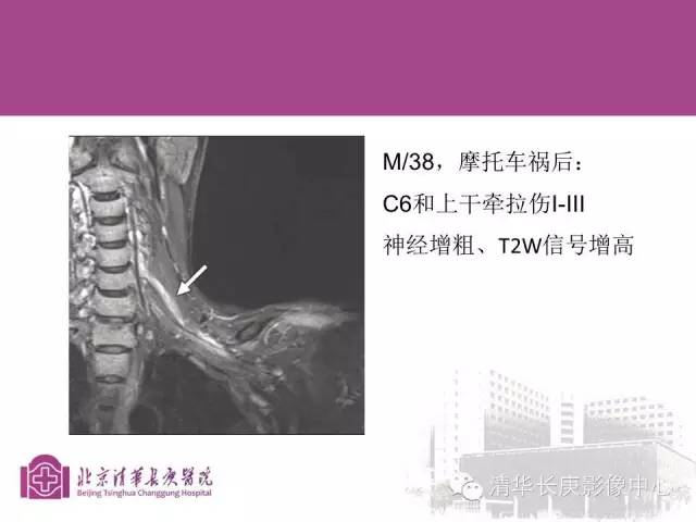 【PPT】臂丛的MR成像