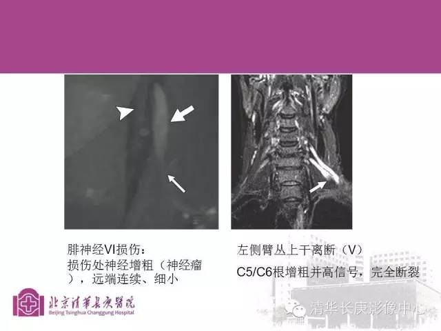 【PPT】臂丛的MR成像