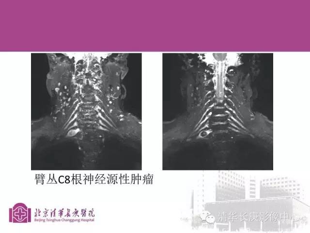 【PPT】臂丛的MR成像