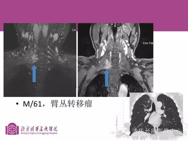 【PPT】臂丛的MR成像