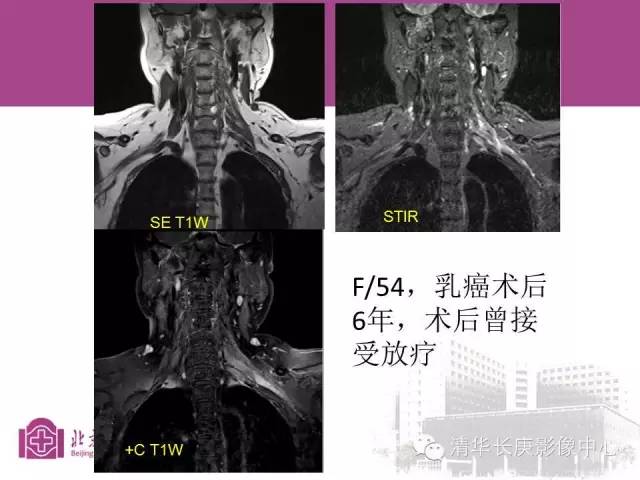 【PPT】臂丛的MR成像