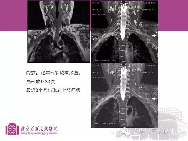 【PPT】臂丛的MR成像