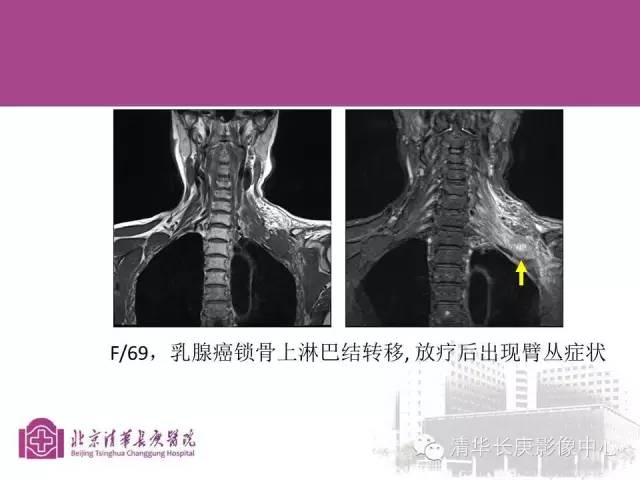 【PPT】臂丛的MR成像