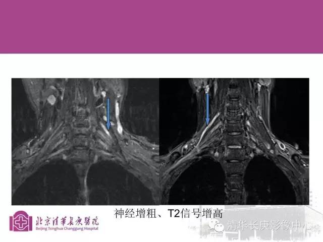 【PPT】臂丛的MR成像