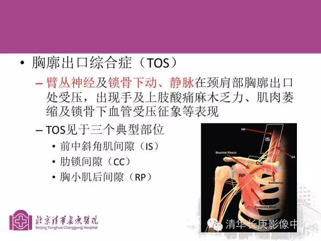 【PPT】臂丛的MR成像