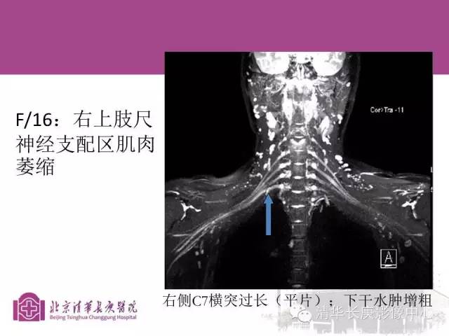 【PPT】臂丛的MR成像