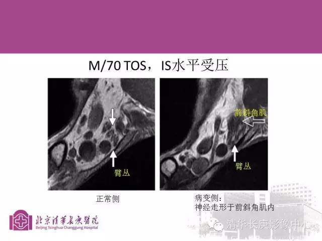 【PPT】臂丛的MR成像