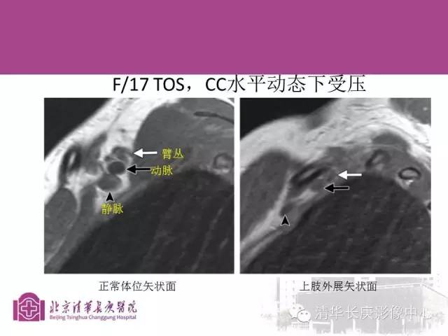 【PPT】臂丛的MR成像